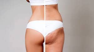 What is cellulite